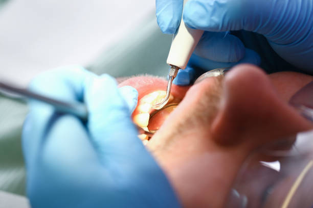 Best Emergency Root Canal Treatment in Mocksville, NC