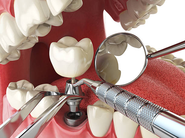 Best Emergency Wisdom Teeth Removal in Mocksville, NC