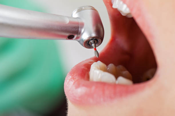 Best Emergency Wisdom Teeth Removal in Mocksville, NC